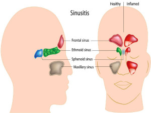 26-1458992497-1-sinusinfection